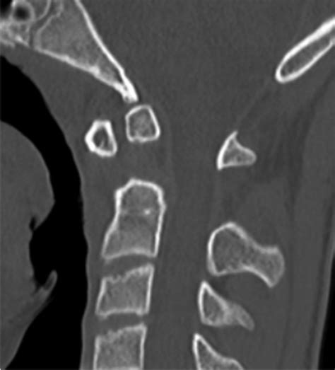 25 Os Odontoideum | Radiology Key