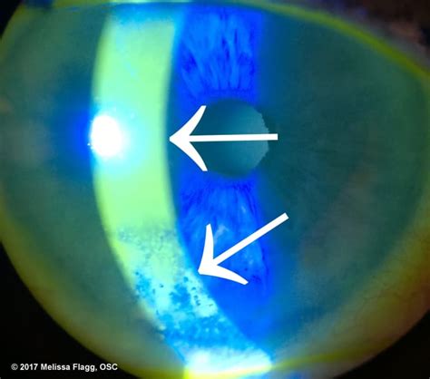 Anatomy of the Eye: The Tear Film, Lids, and Lacrimal Glands ...