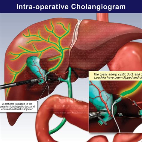 Intra-operative Cholangiogram Anterior View - TrialExhibits Inc.