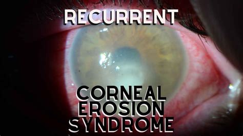 Recurrent Corneal Erosion Syndrome - Dr Anthony Maloof, Sydney