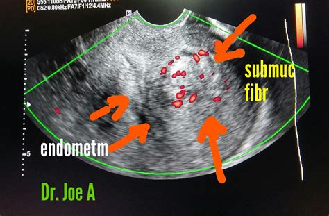 Ultrasound imaging: Submucosal-fibroid-vascular