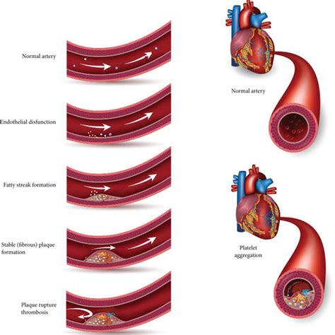 Process of platelet aggregation and formation of thrombosis during CVDs. | Download Scientific ...