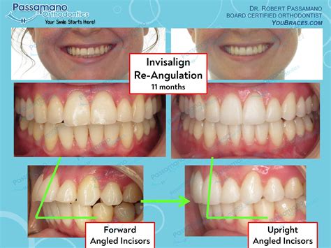 Invisalign Before And After Crowding