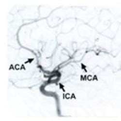 Cerebral Angiogram to Diagnose Moyamoya | Stanford Health Care