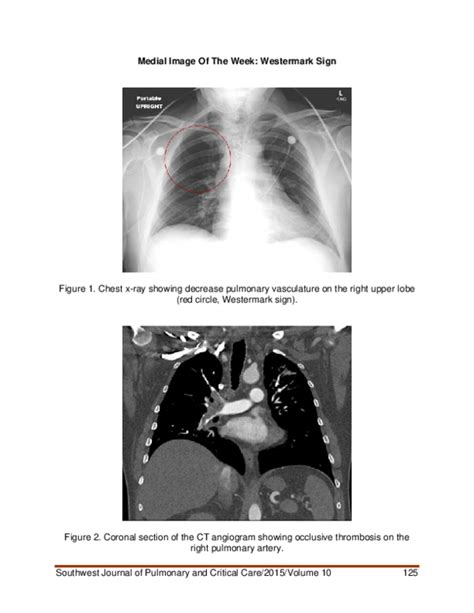 (PDF) Medical image of the week: Westermark sign | muna omar - Academia.edu