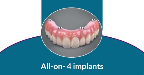 All on 4 Dental Implants Near Me | Glendale Family Dentist