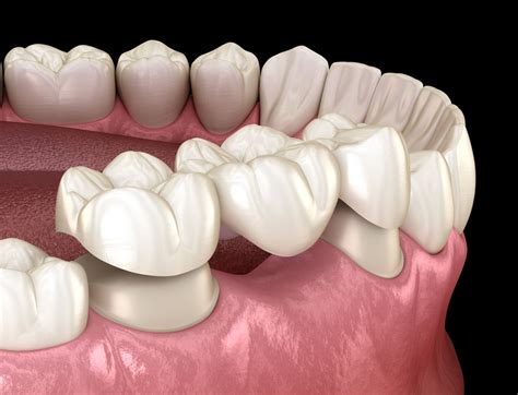 The 5 less invasive alternatives to dental implants | Dental Centre Mallorca