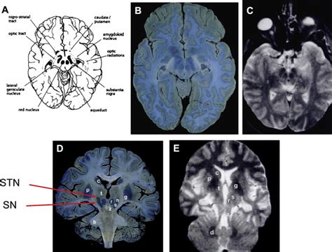 Anatomy of the Substantia Nigra and Subthalamic Nucleus on MR Imaging | Radiology Key