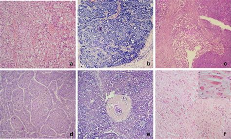 Histological subtypes of hepatoblastoma: a Fetal subtype of... | Download Scientific Diagram