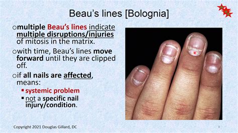 Dermatology: (Wk9)(Win21): Longitudinal ridges, Beau's lines, and Ringworm (dermatophytosis ...