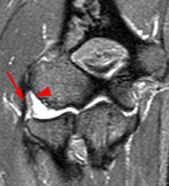 Ulnar Collateral Ligament Mri