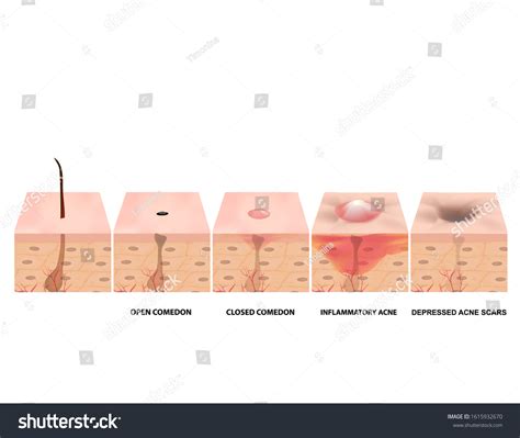 Treatment Open Comedones Inflamed Acne Acne Stock Illustration 1615932670 | Shutterstock