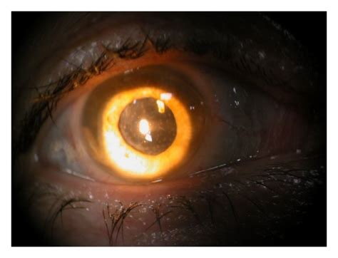 Pseudophakia, secondary cataract, and anterior granulomatous uveitis in... | Download Scientific ...