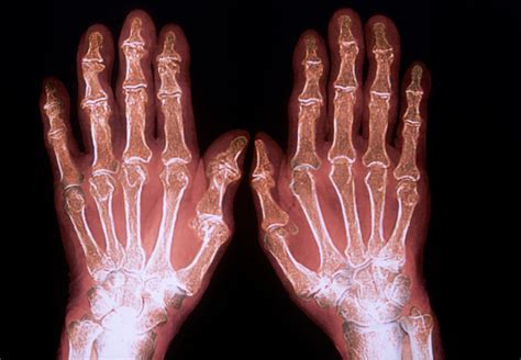 Understanding Arthritis: Types, Symptoms, and Treatment Options - Becker Spine