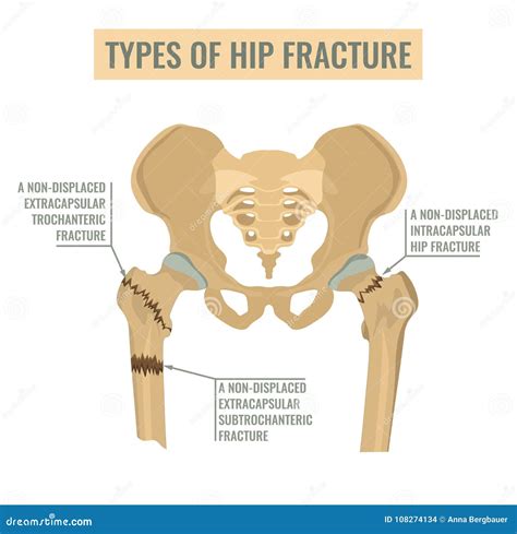 Types of hip fracture stock vector. Illustration of diagnosis - 108274134