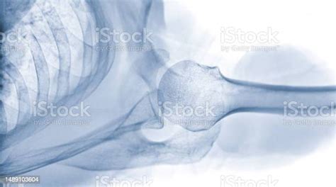 Xray Shoulder Joint Shoulder Transaxillary View For Diagnosis Fracture ...