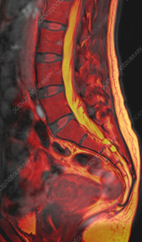Healthy lower spine, MRI scan - Stock Image - F039/4353 - Science Photo ...