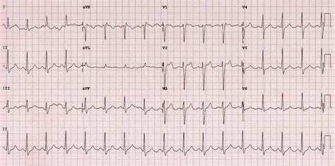 Pin on EKG