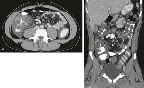 Inflammatory and Infectious Diseases | Radiology Key