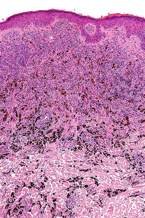 Melanocytic lesions - Libre Pathology