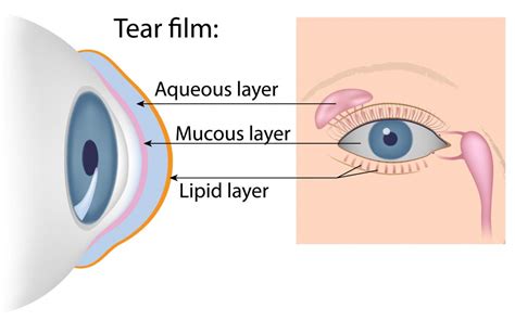 Dry Eye Syndrome - First Eye Care Downtown Dallas