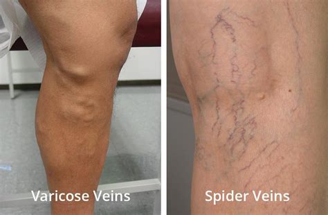 What is the difference between varicose veins and spider veins? - California Vein & Wound Center