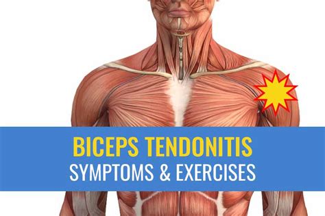 Biceps tendonitis treatment: Causes, symptoms, exercises, and recovery times