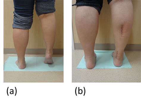 Achilles tendon lengthening | The Foot and Ankle Online Journal