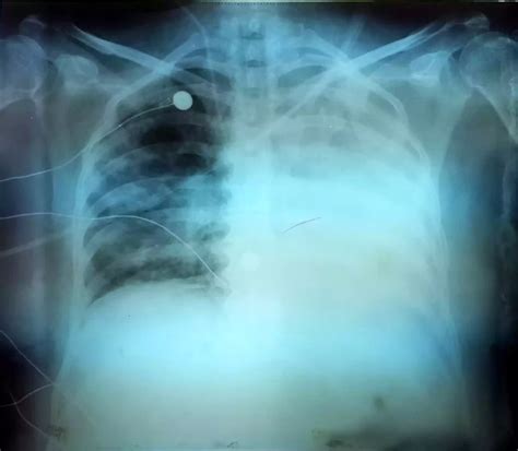 Barotrauma and Volutrauma - best difference