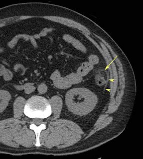 RiT radiology: Epiploic Appendagitis