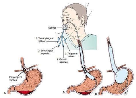 Esophageal Veins