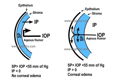 Corneal Edema Grading