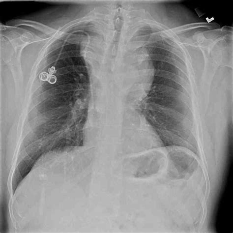 [Figure, Periapical (PA) Chest Radiograph, Anterior...] - StatPearls - NCBI Bookshelf