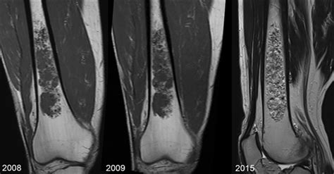 Enchondromas of Long Bones and Other Skeletal Lesions Found ...