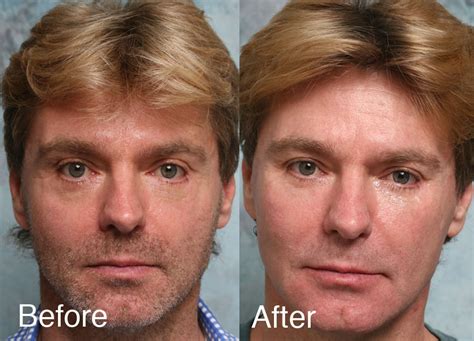 Fixing Botched Lower Eyelids Surgery | Repair Lower Eyelid Gone Wrong