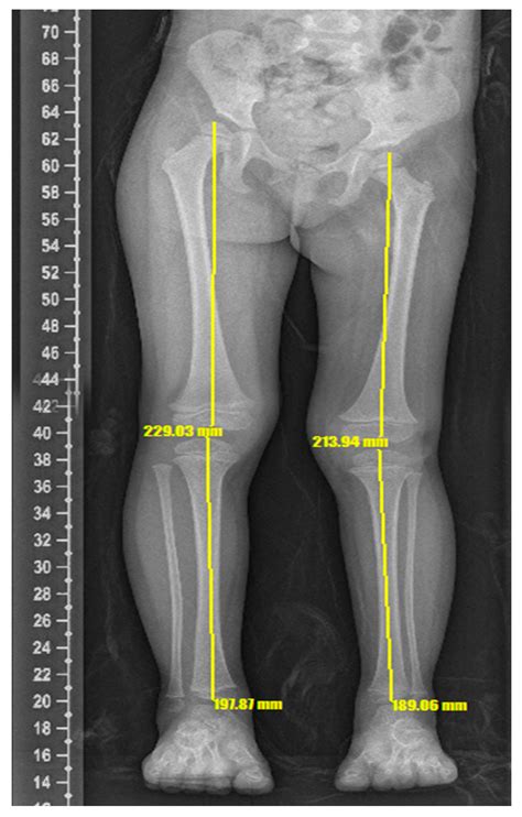 Surgeries | Free Full-Text | Crossed Congenital Hemihyperplasia: A Case ...