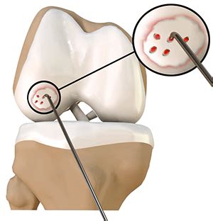 Knee Fracture Surgery Baton Rouge | Chondroplasty | Knee Arthroscopy Gonzales