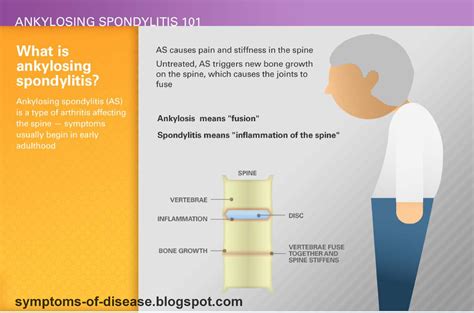 ankylosing spondylitis symptoms | Symptoms of Disease