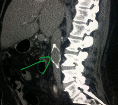 #Abdomen #CT #scan shows an #IVC #filter which can block #clots from going into the #lungs. # ...