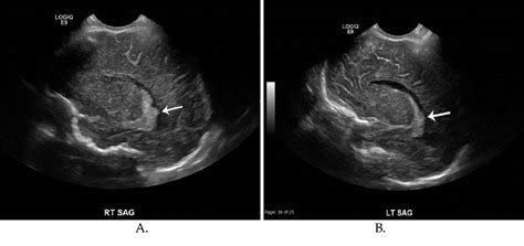 [PDF] Pediatric Cranial Ultrasound: Techniques, Variants and Pitfalls | Semantic Scholar