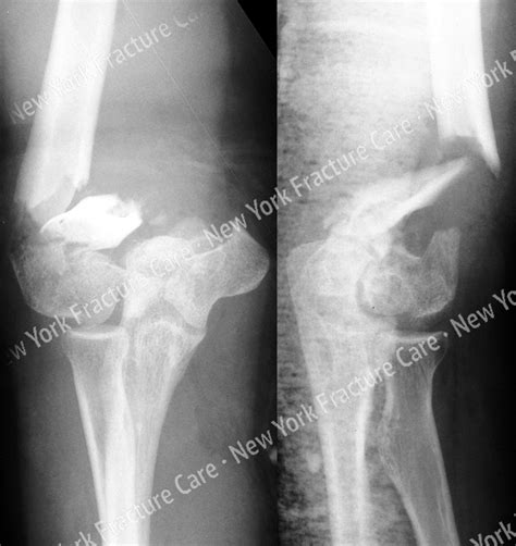 Elbow fractures - New York Fracture Care