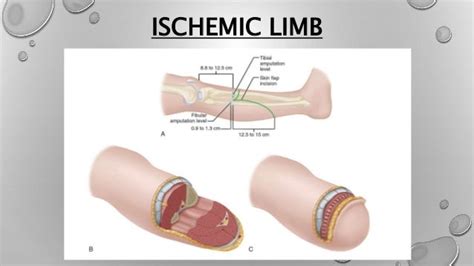 Lower limb amputation