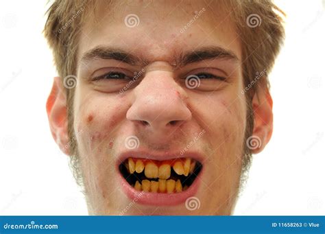 Yellow Teeth stock image. Image of dental, weird, gingivitis - 11658263