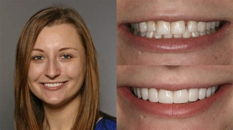 Before & After Composite Veneers Treatment 8