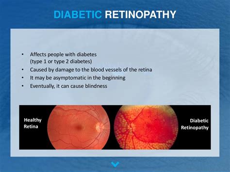 The Most Common Retinal Diseases