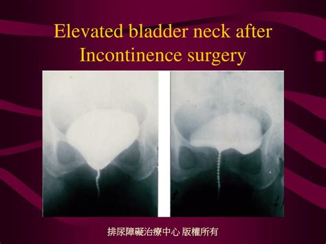 PPT - Surgical Treatment of Stress Urinary Incontinence PowerPoint ...