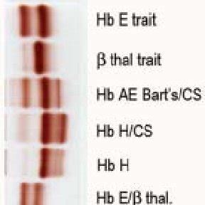 Hemoglobin analysis of Hb H-Hb CS patient showing Hb Bart's, Hb H, Hb ...