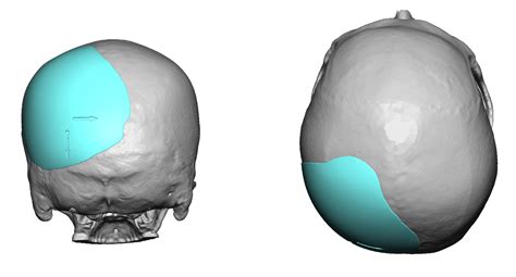 » Blog ArchiveCase Study - Custom Skull Implant for Occipital ...