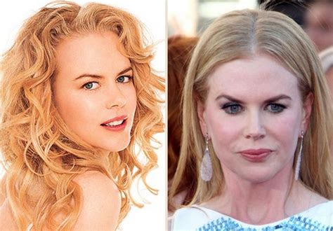 Nicole Kidman plastic surgery for puffy look