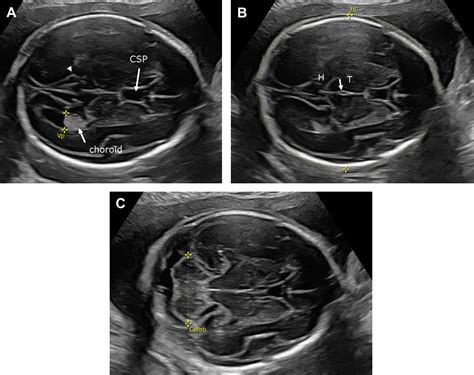 Ultrasound and MR Imaging of the Normal Fetal Brain - Neuroimaging Clinics